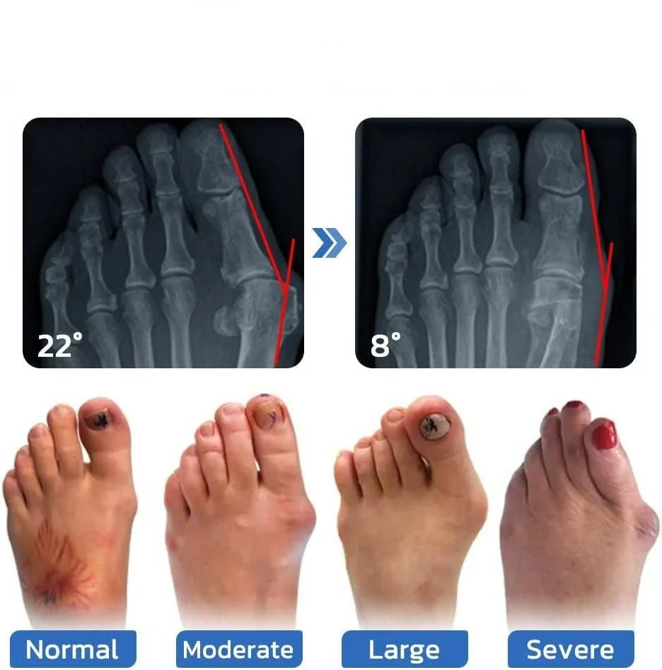 Anti - Bunion & Vein Health Socks for Women & Men - ThriveAuraOutlet